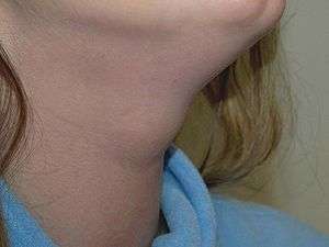 Exampleof Thyroglossal Duct Cyst.