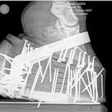 An X-ray of a horse's hoof, attached to a thick set of pads filled with nails